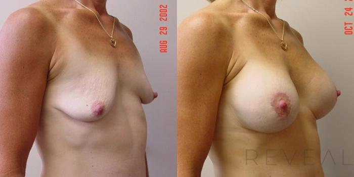 Before & After Breast Augmentation Case 4 View #3 View in San Jose, CA