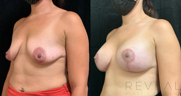 Before & After Breast Lift Case 498 View #2 View in San Jose, CA