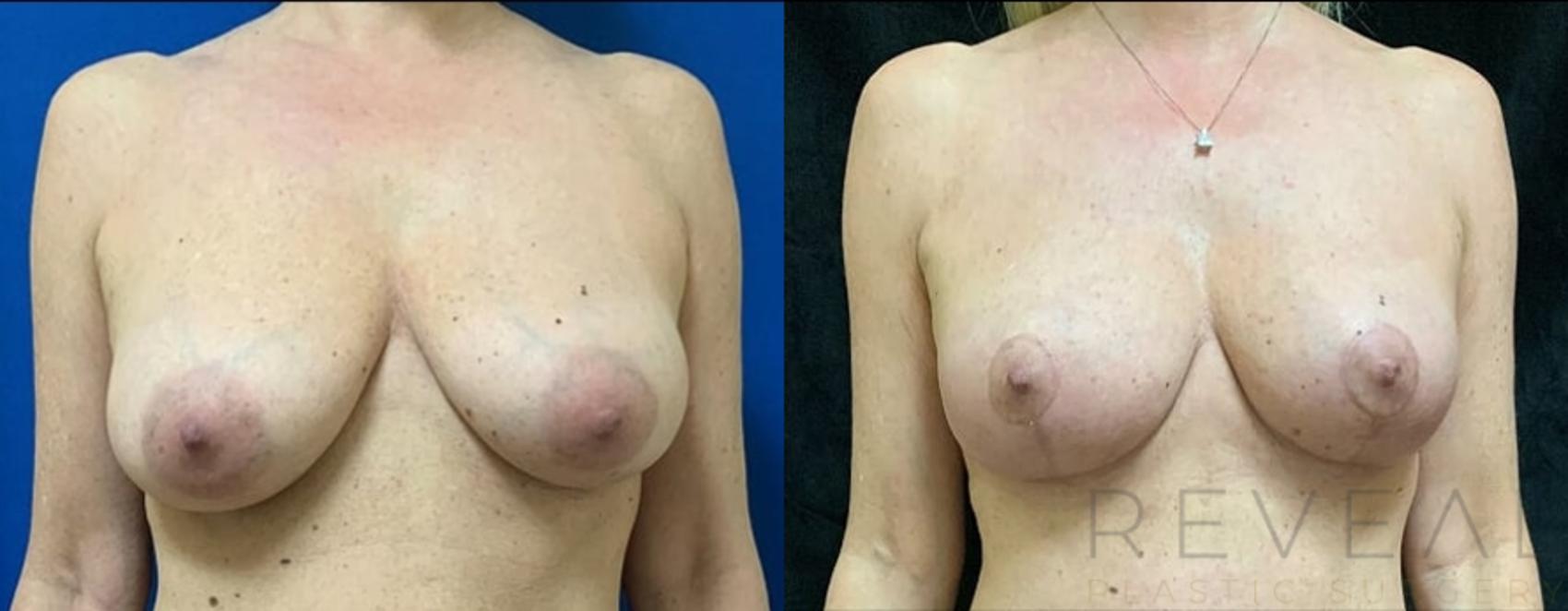 Before & After Breast Lift Case 499 View #1 View in San Jose, CA