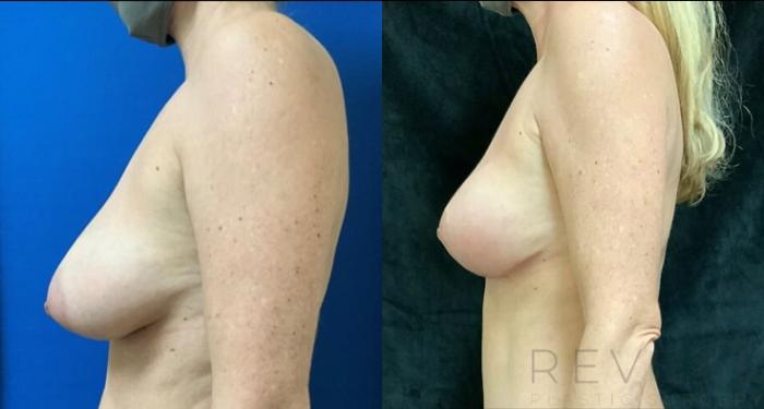 Before & After Breast Lift Case 499 View #2 View in San Jose, CA