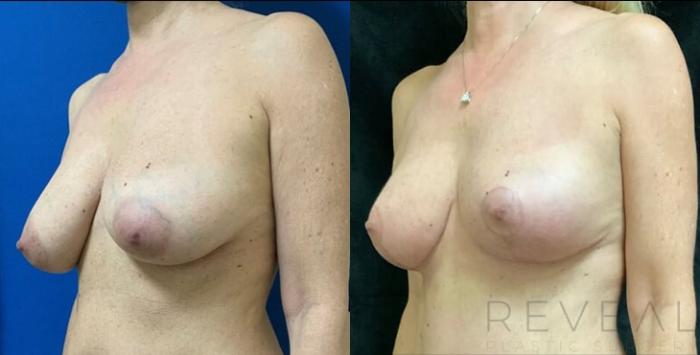 Before & After Breast Lift Case 499 View #3 View in San Jose, CA