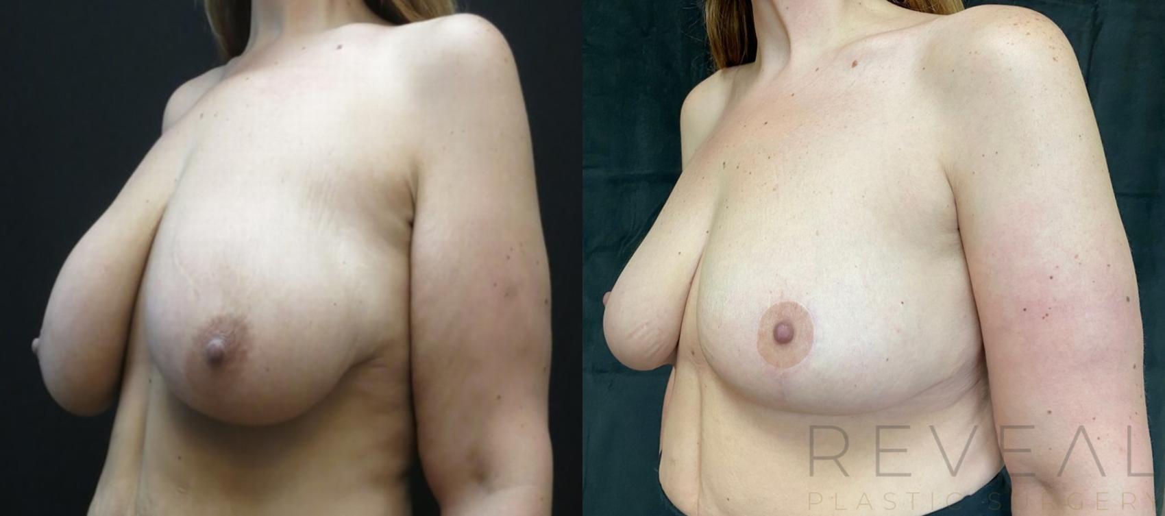 Before & After Breast Lift Case 502 View #1 View in San Jose, CA