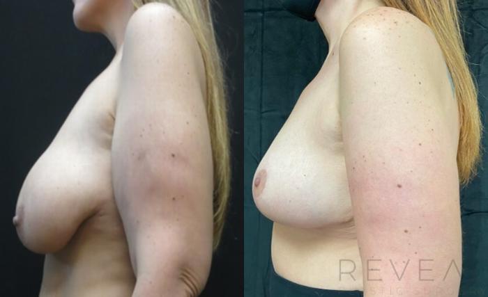 Before & After Breast Lift Case 502 View #2 View in San Jose, CA