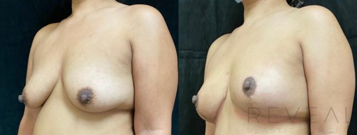 Before & After Breast Lift Case 506 View #2 View in San Jose, CA
