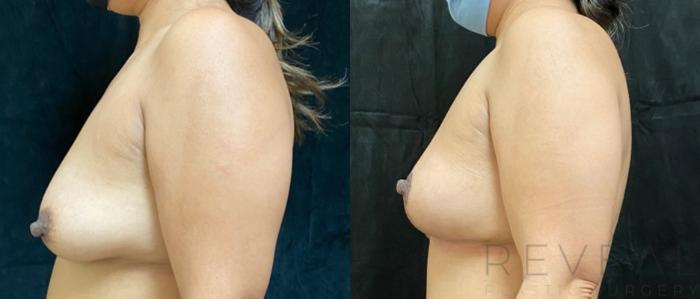 Before & After Breast Lift Case 506 View #3 View in San Jose, CA