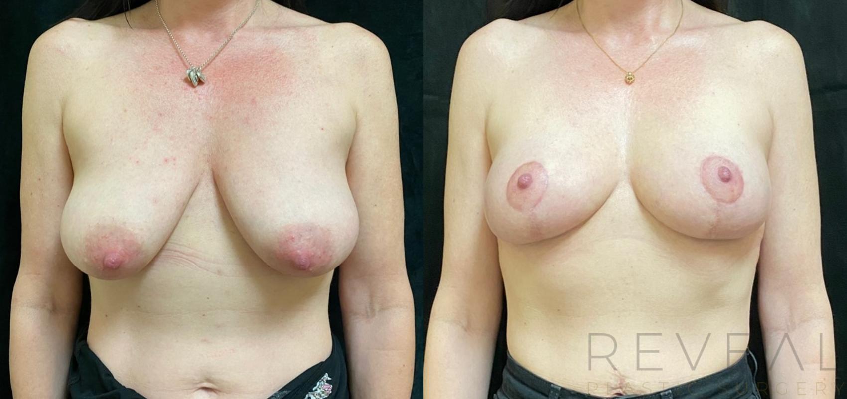 Before & After Breast Lift Case 530 View #1 View in San Jose, CA