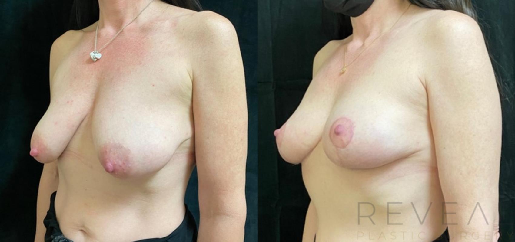 Before & After Breast Lift Case 530 View #2 View in San Jose, CA