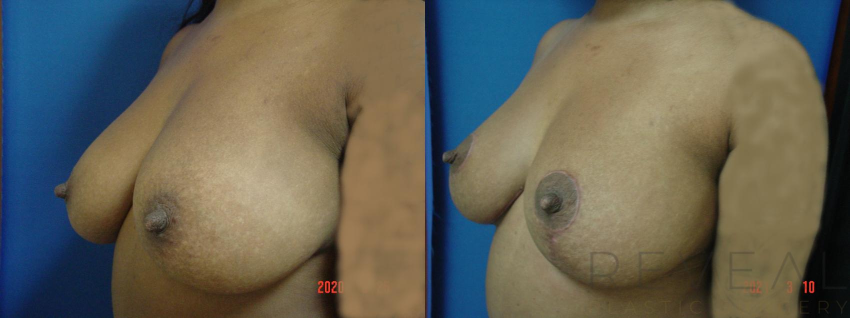Before & After Liposuction Case 543 View #1 View in San Jose, CA