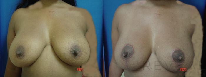 Before & After Breast Lift Case 543 View #2 View in San Jose, CA