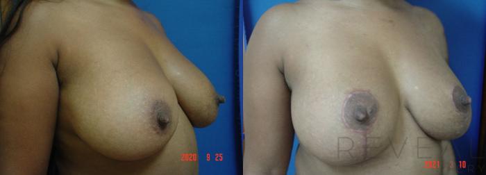 Before & After Breast Lift Case 543 View #3 View in San Jose, CA