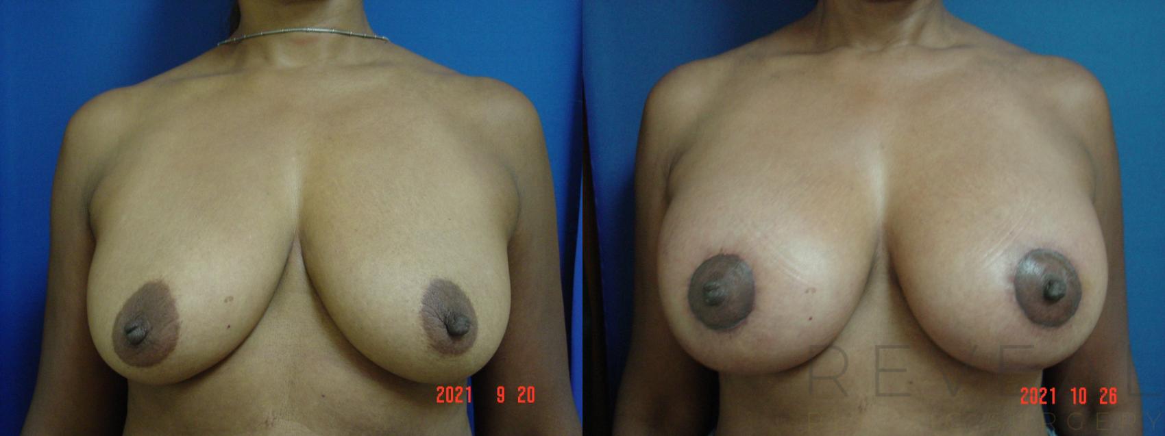 Before & After Breast Augmentation Case 592 Front View in San Jose, CA
