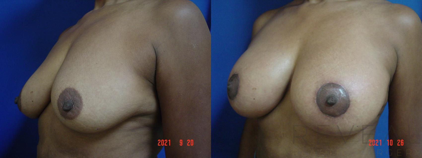 Before & After Breast Lift Case 592 Left Oblique View in San Jose, CA