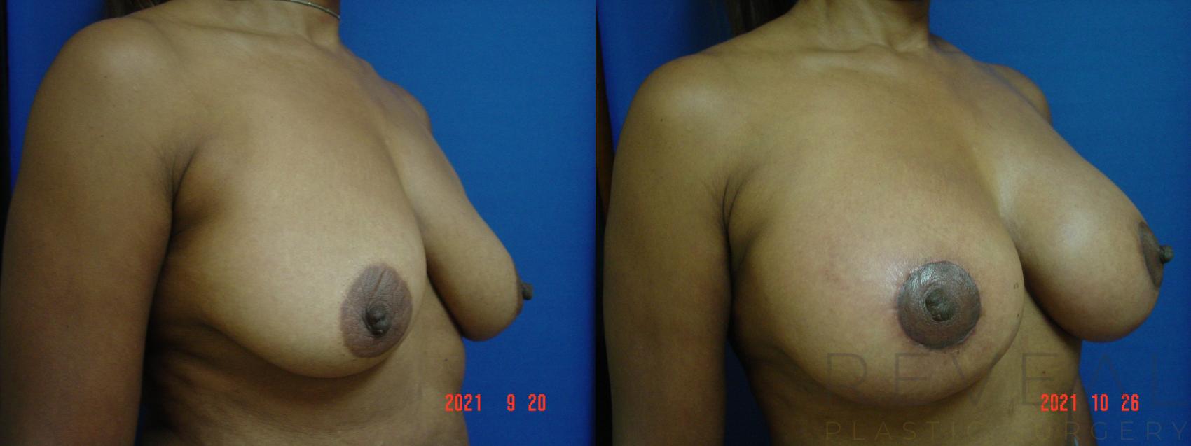 Before & After Breast Lift Case 592 Right Oblique View in San Jose, CA