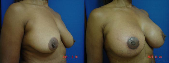 Before & After Breast Augmentation Case 592 Right Oblique View in San Jose, CA