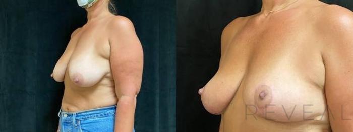 Before & After Breast Lift Case 621 Left Oblique View in San Jose, CA