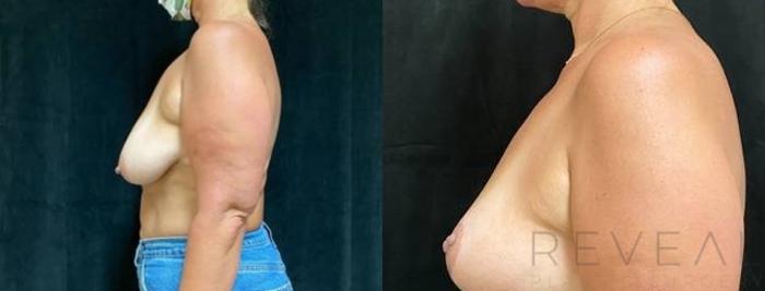 Before & After Breast Lift Case 621 Left Side View in San Jose, CA