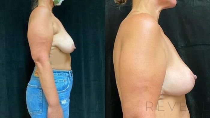 Before & After Breast Lift Case 621 Right Side View in San Jose, CA