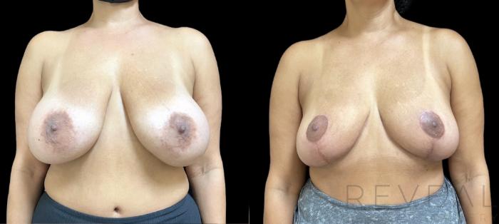Before & After Breast Reduction Case 649 Front View in San Jose, CA