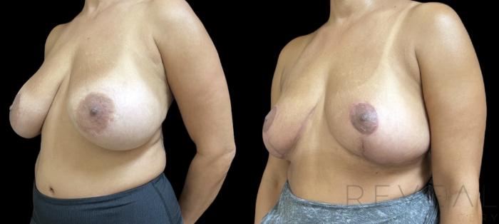 Before & After Breast Lift Case 649 Left Side View in San Jose, CA