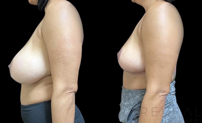Before & After Breast Reduction Case 649 Right Side View in San Jose, CA