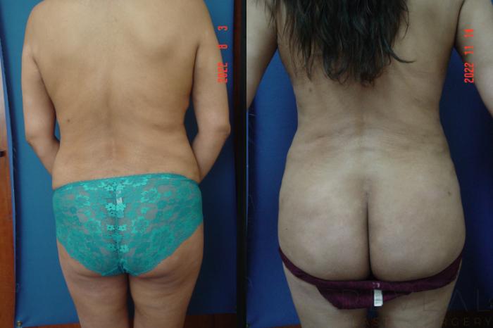 Before & After Brazilian Butt Lift Case 690 Back View in San Jose, CA
