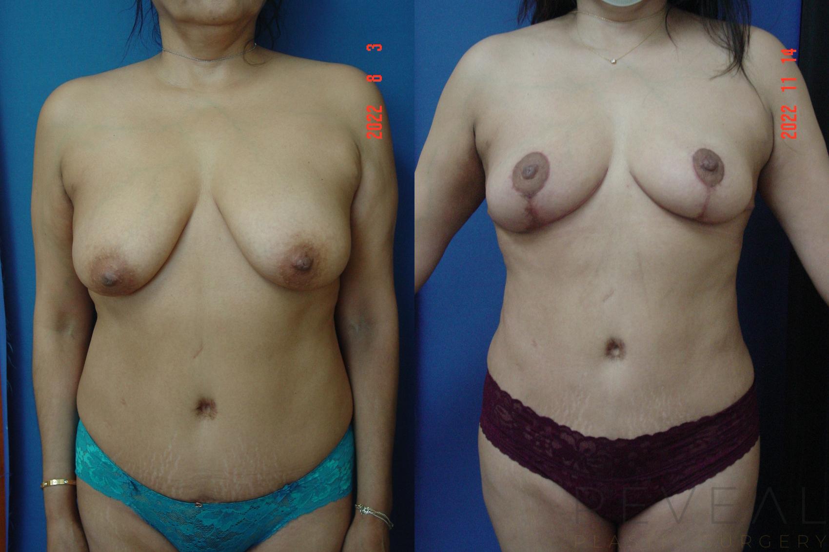 Before & After Breast Lift Case 690 Front View in San Jose, CA