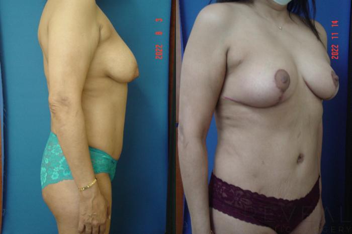 Before & After Breast Lift Case 690 Left Side View in San Jose, CA