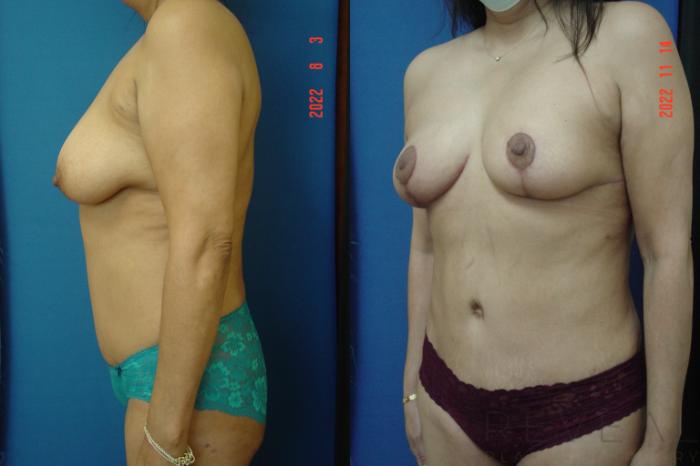 Before & After Breast Lift Case 690 Right Side View in San Jose, CA