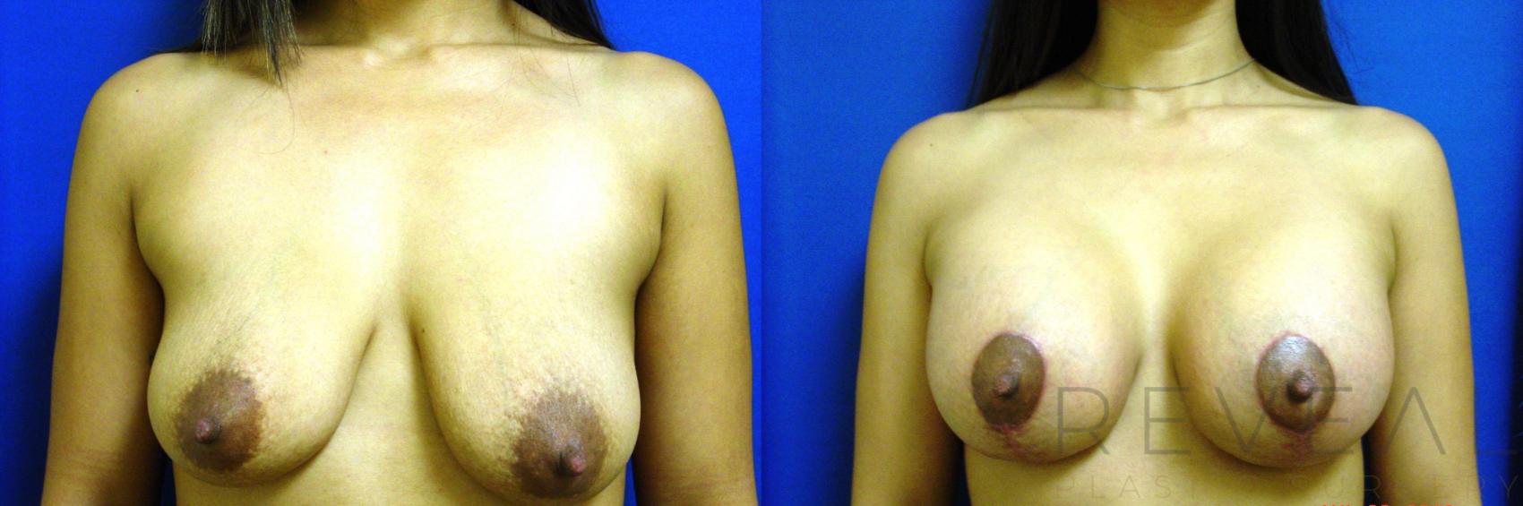 Before & After Breast Augmentation Case 98 View #1 View in San Jose, CA