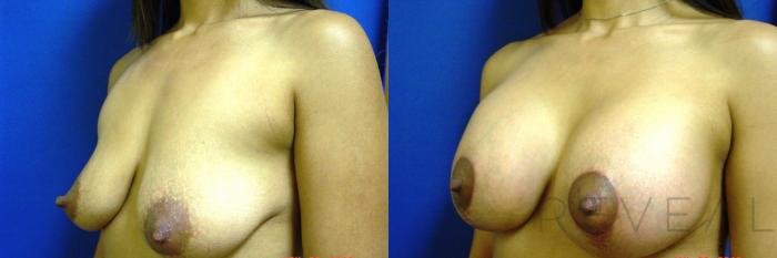 Before & After Breast Lift Case 98 View #2 View in San Jose, CA