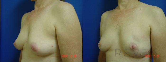 Before & After Breast Reconstruction Case 152 View #1 View in San Jose, CA