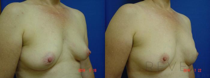 Before & After Breast Reconstruction Case 152 View #3 View in San Jose, CA