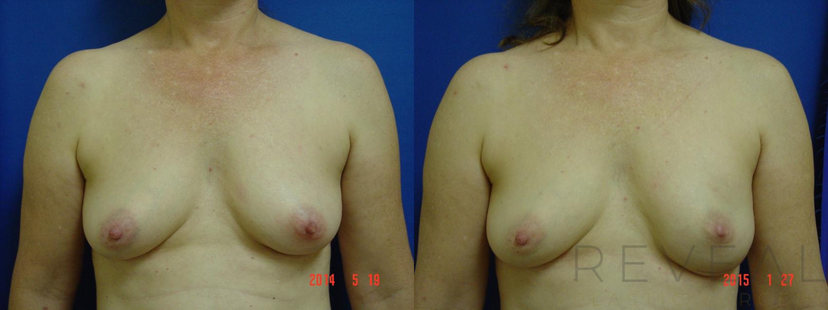 Before & After Breast Reconstruction Case 169 View #1 View in San Jose, CA