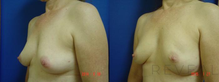Before & After Breast Reconstruction Case 169 View #2 View in San Jose, CA
