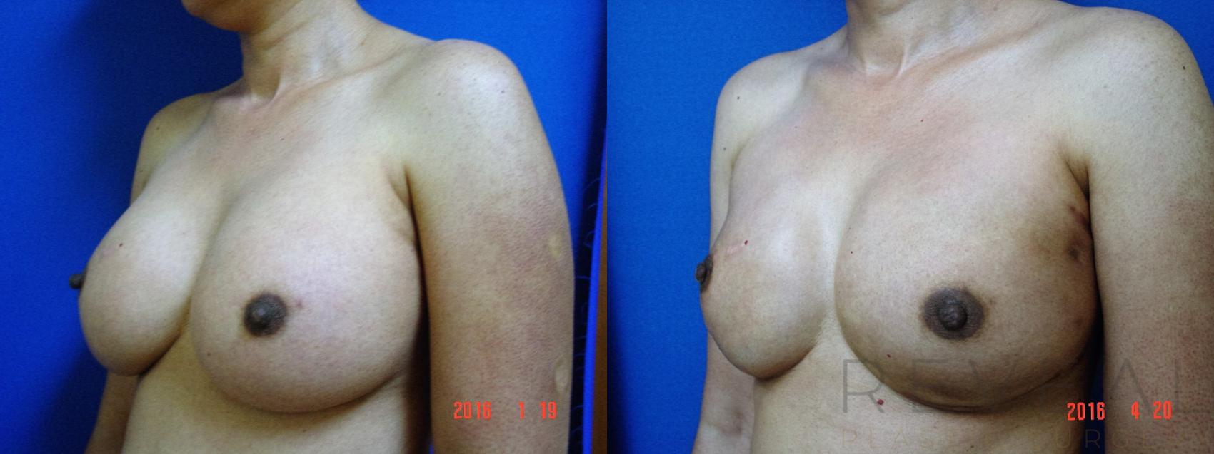 Before & After Breast Reconstruction Case 189 View #1 View in San Jose, CA