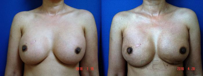 Before & After Breast Reconstruction Case 189 View #2 View in San Jose, CA