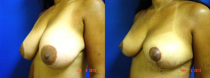 Before & After Breast Reduction Case 103 View #2 View in San Jose, CA