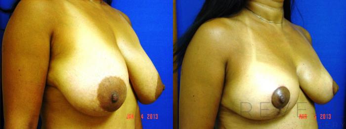 Before & After Breast Reduction Case 103 View #3 View in San Jose, CA