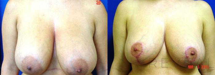 Before & After Breast Reduction Case 104 View #1 View in San Jose, CA