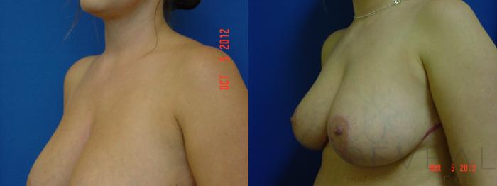 Before & After Breast Reduction Case 104 View #2 View in San Jose, CA