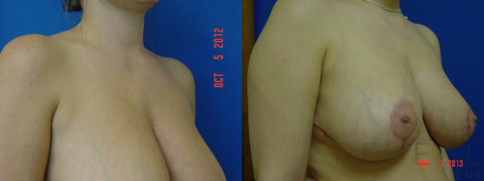 Before & After Breast Reduction Case 104 View #3 View in San Jose, CA