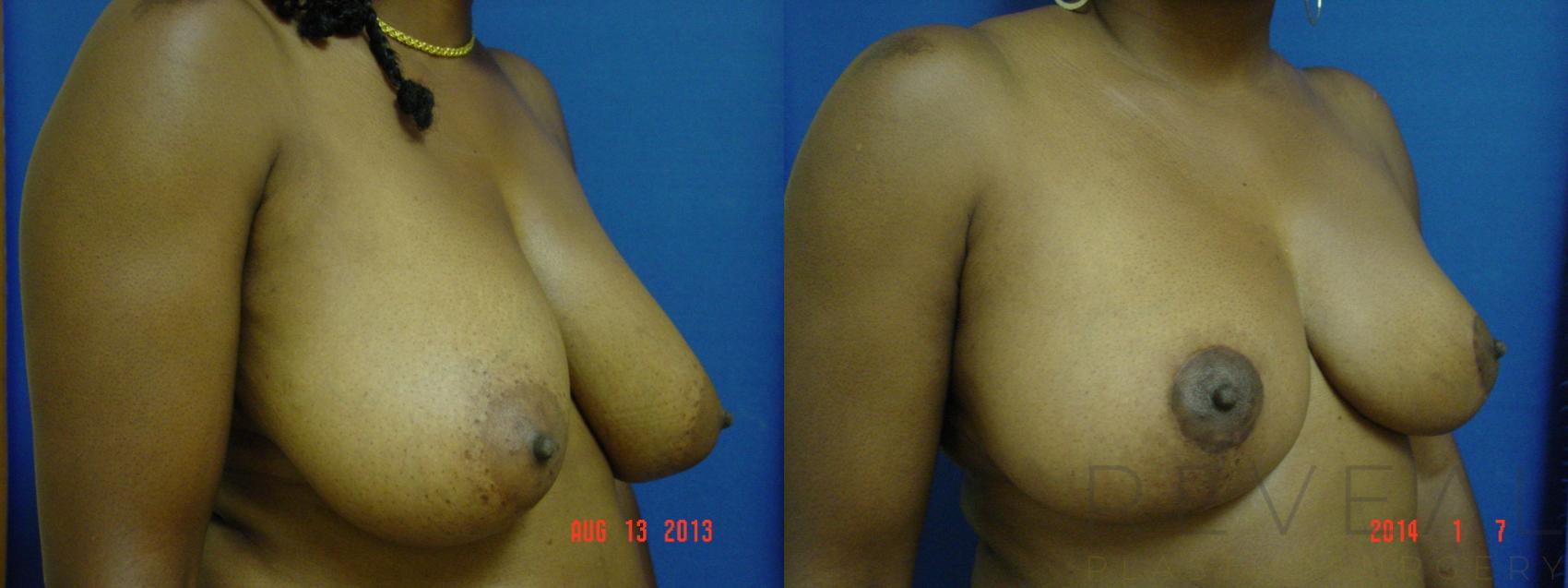 Before & After Breast Reduction Case 125 View #1 View in San Jose, CA