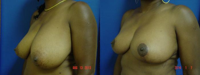 Before & After Breast Reduction Case 125 View #2 View in San Jose, CA