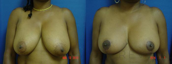 Before & After Breast Reduction Case 125 View #3 View in San Jose, CA