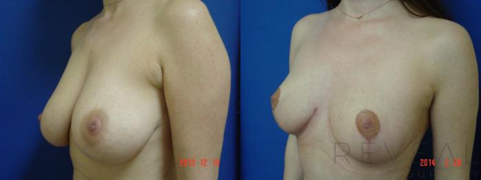 Before & After Breast Reduction Case 133 View #2 View in San Jose, CA