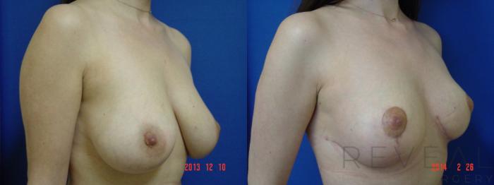 Before & After Breast Lift Case 133 View #3 View in San Jose, CA