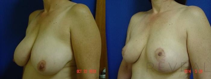 Before & After Breast Reduction Case 143 View #2 View in San Jose, CA