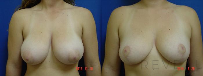 Before & After Breast Reduction Case 153 View #1 View in San Jose, CA