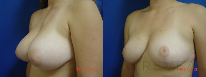 Before & After Breast Reduction Case 153 View #2 View in San Jose, CA