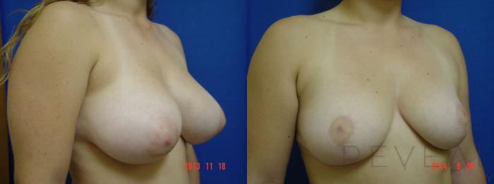 Before & After Breast Reduction Case 153 View #3 View in San Jose, CA